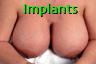 Implants